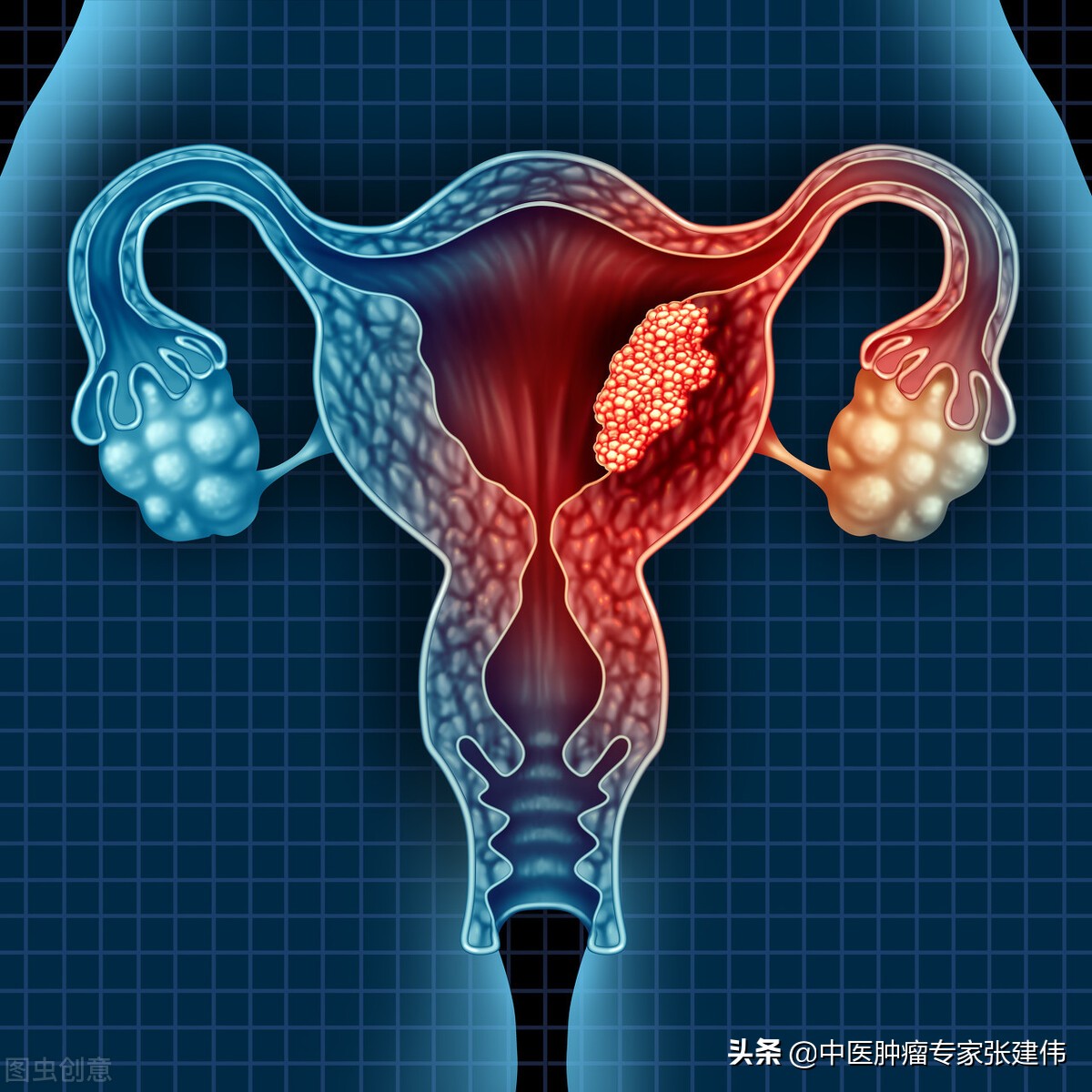 tct宫颈癌筛查报告单,2023年tct宫颈癌报告单