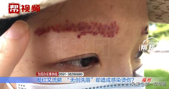 无创洗眉真的不会留疤吗,无创洗眉最后绝对不留疤痕吗
