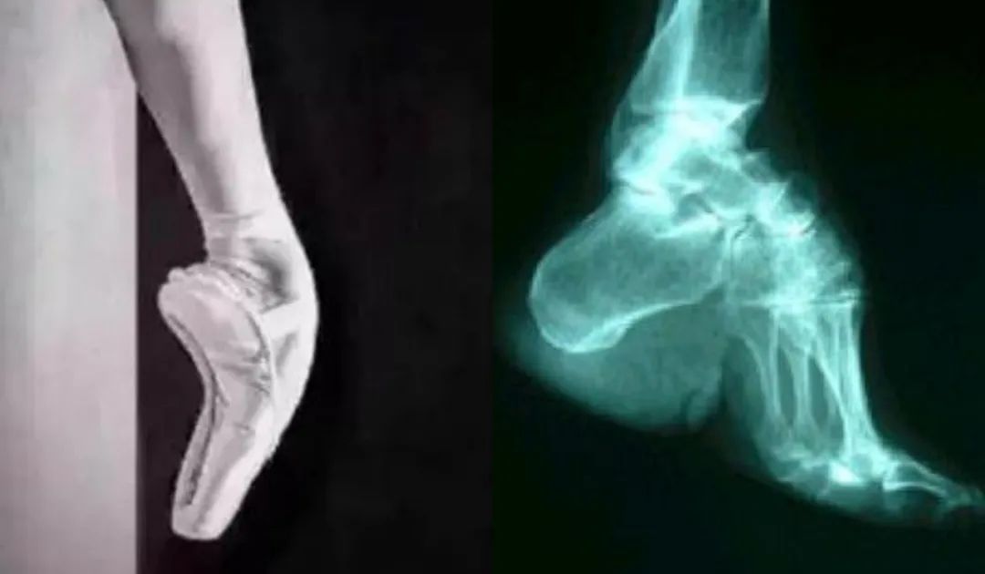 练芭蕾会导致膝超伸吗,练芭蕾舞的脚有多可怕