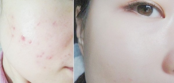 皮肤痘印如何消除,皮肤痘印怎么消除