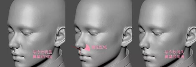 鼻基底严重法令纹很深怎么遮盖,鼻基底凹陷法令纹瘦下去会改善吗