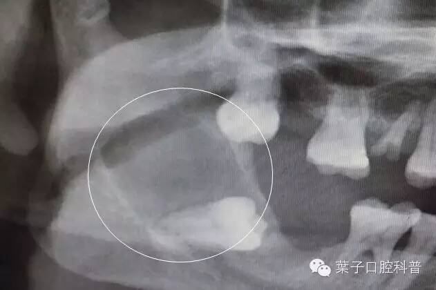 拔智齿十大危害,拔智齿利与弊