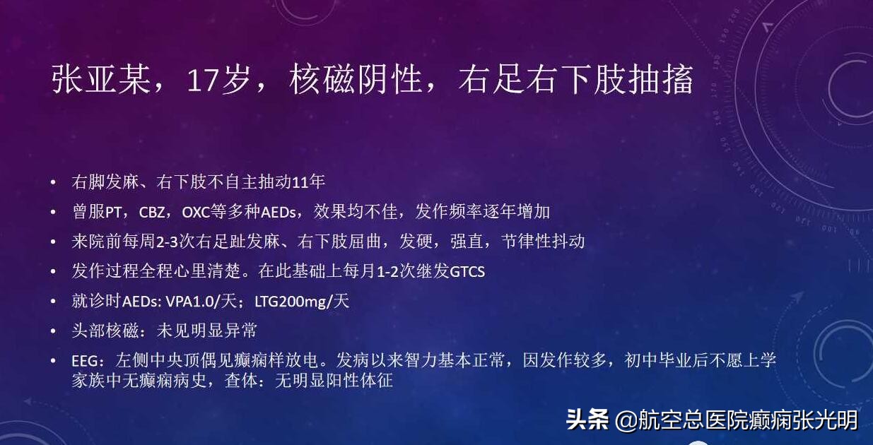 张光明左颞叶癫痫手术成功率,张光明谈治疗癫痫的方法有哪些