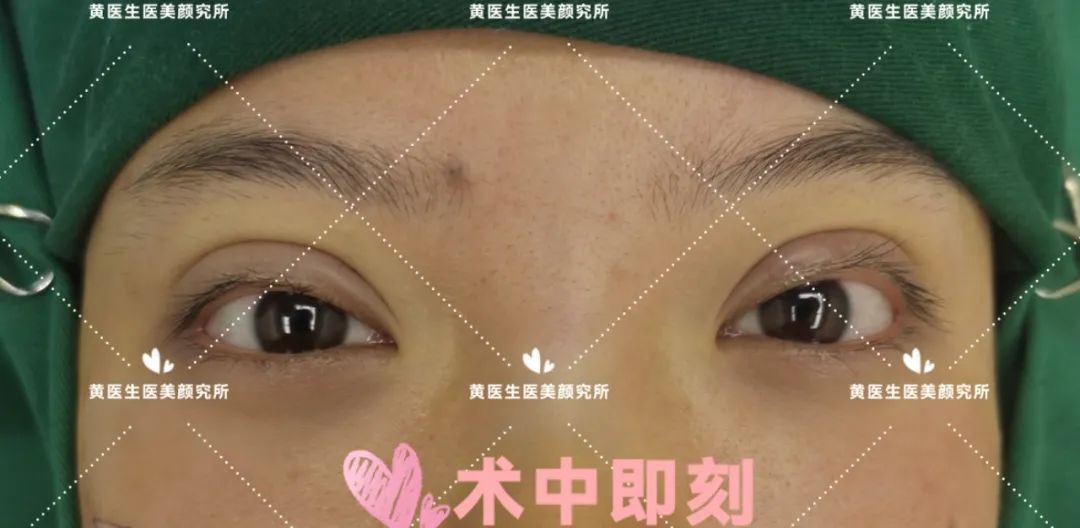 微创双眼皮10毫米,微创双眼皮切口一般多久愈合