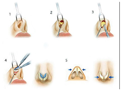 鼻外伤的症状和治疗方法,外伤鼻中隔弯曲手术有必要做吗
