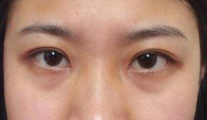 严重泪沟黑眼圈,淡化黑眼圈和泪沟原理