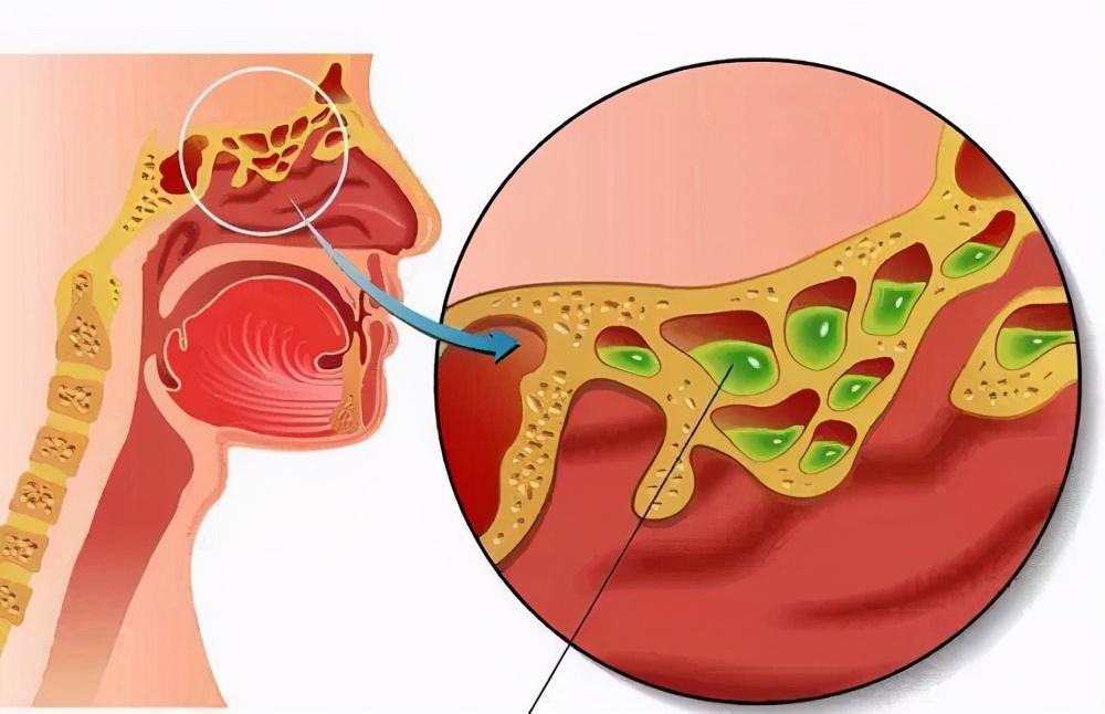 鼻中隔偏曲鼻塞不做手术,鼻中隔偏曲需要做手术吗会复发