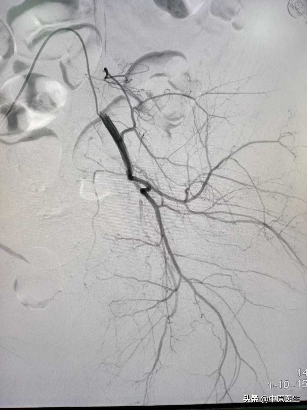 宫颈鳞癌需要切除哪里,宫颈鳞癌出血怎么处理
