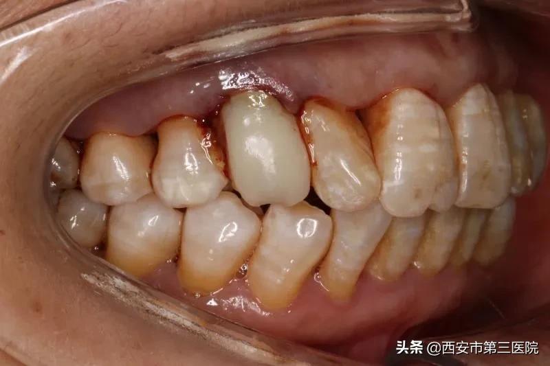 关注口腔健康的策划案例,关注口腔健康数字化种植牙