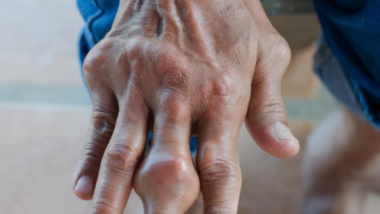 痛风的人很多，还在胡吃海塞？至少8000万国人正在受它折磨