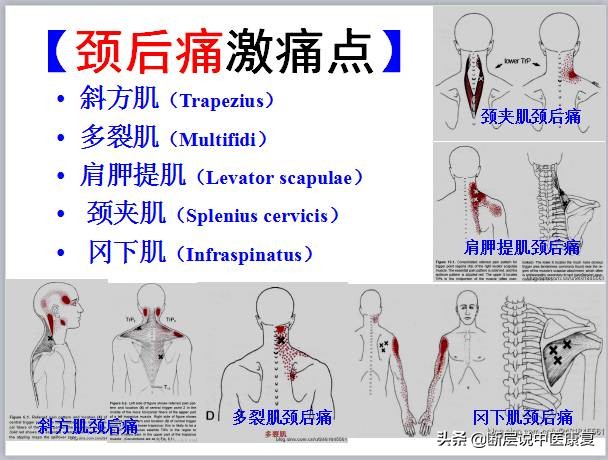激痛点挂图,激痛点疗法笔记