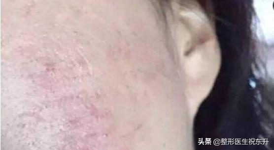 关于超声刀,超声刀后果严重吗