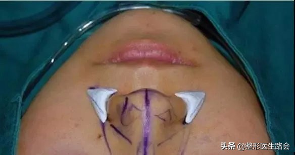 膨体垫鼻基底能管一辈子吗,膨体垫鼻基底要打钉子吗