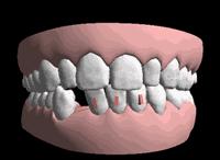 三d动画立体展示牙齿矫正全过程,3d牙齿矫正变化过程动图