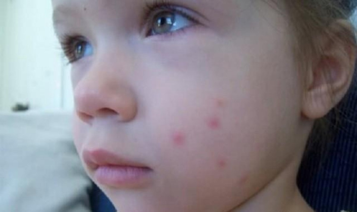 宝宝被蚊子叮咬后的小科普下,宝宝被蚊子叮咬之后的正确处理