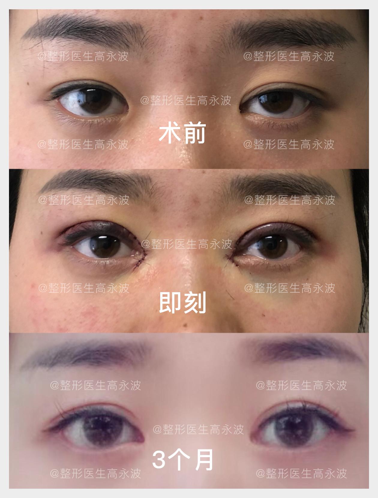 做双眼皮有增生了怎么办,做了双眼皮以后增生了怎么办