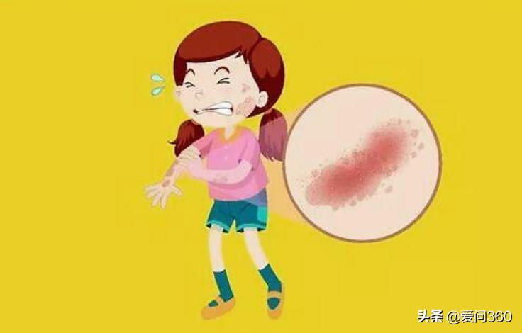 荨麻疹遇热重遇冷缓解怎么治,麻疹出现皮肤瘙痒用什么止痒