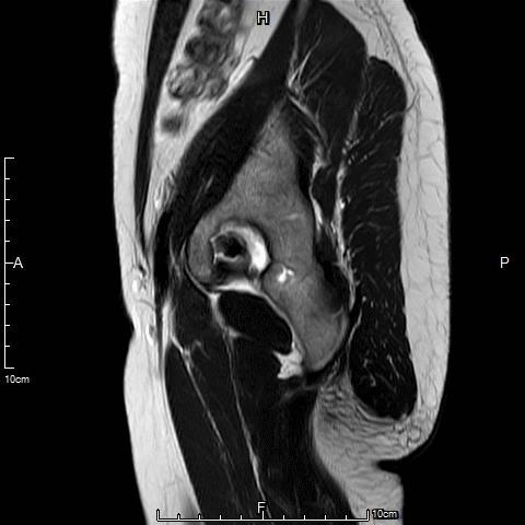 囊性子宫腺肌病的特点是什么,囊性腺肌病最佳治疗方案