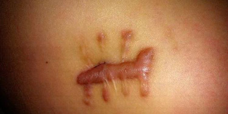 瘢痕疙瘩不治疗行吗,瘢痕疙瘩最新治疗方法