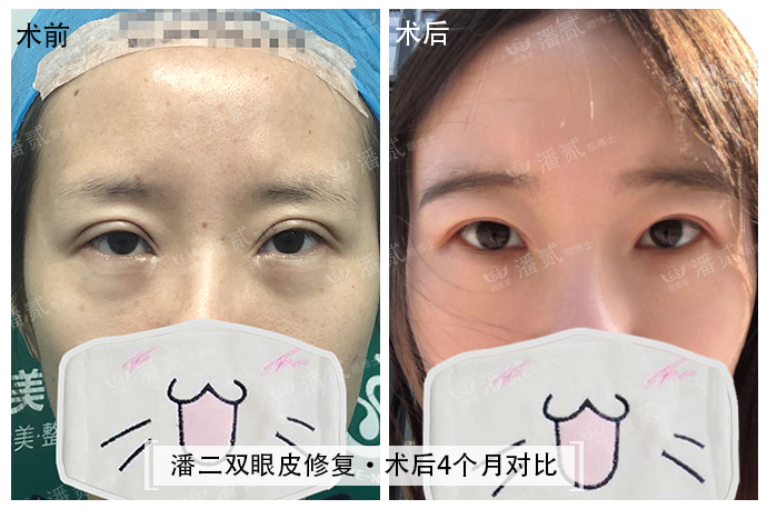 眼角下垂做双眼皮手术可以改变吗,后悔做双眼皮