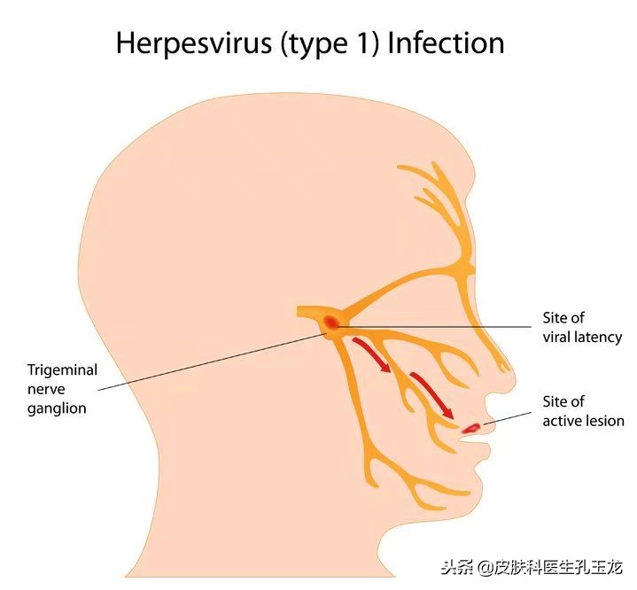 单纯疱疹和上火的区别,脸上的单纯疱疹是上火引起的吗
