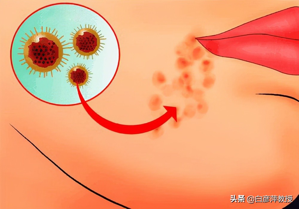 上火下巴嘴角起疱疹怎么回事,嘴角上火起疙瘩疱疹怎么快速消除
