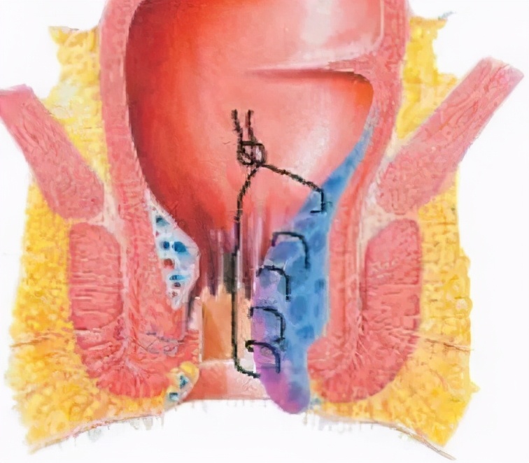 痔疮手术出院后可以不复查吗,痔疮手术后不排便可以出院吗