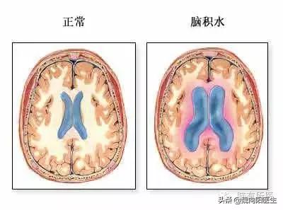 脑出血后积水能好吗,脑出血止住了脑水肿严重吗