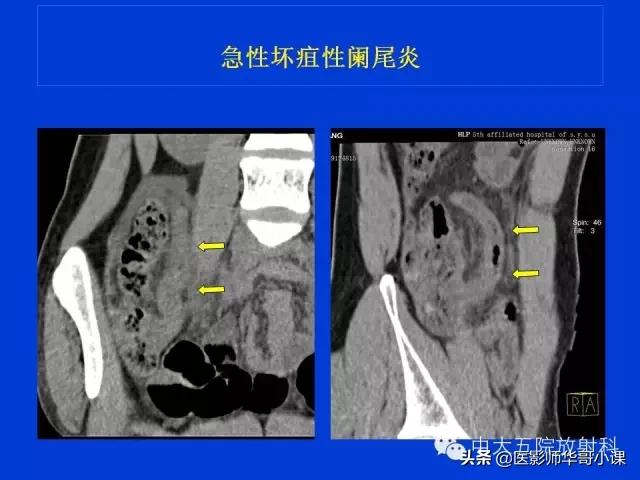 阑尾炎课件,阑尾炎的超声课件