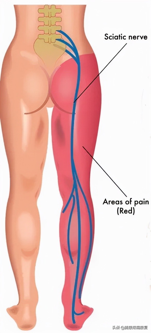 腰椎间盘突出的12组锻炼动作,腰椎间盘4-5节突出压迫神经怎么办