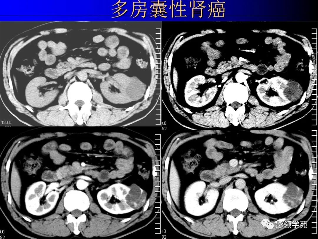 肾脏囊性肿块的影像学特点,肾脏典型病理图片及解析