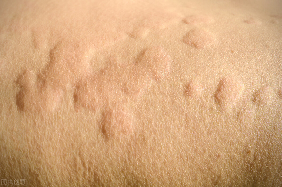 寒性荨麻疹止痒最有效方法,中药治疗荨麻疹止痒最有效方法