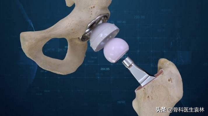 股骨头坏死最新的治疗方法,股骨头坏死的治疗方法