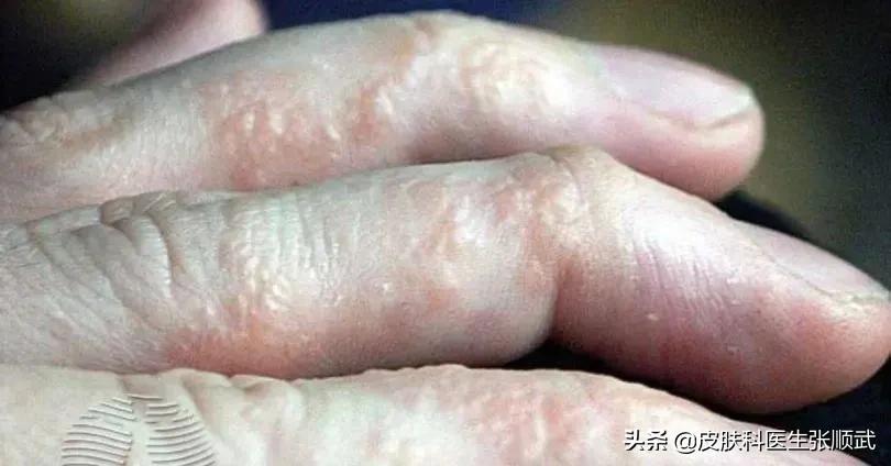 手上小水泡汗疱疹,脚上手上起小水泡很痒可以根治吗