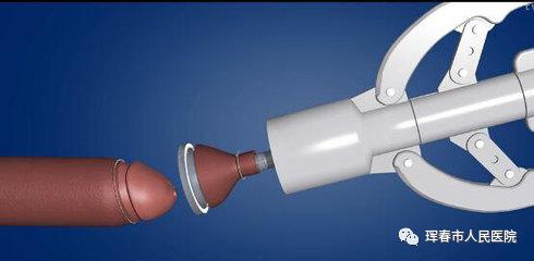 珲春市医院能做包皮过长手术吗,新型一次性包皮环切吻合器手术