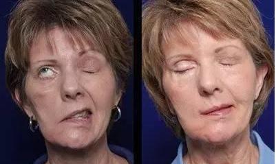 梅杰综合征dbs术后注意事项,梅杰综合征dbs手术后评估