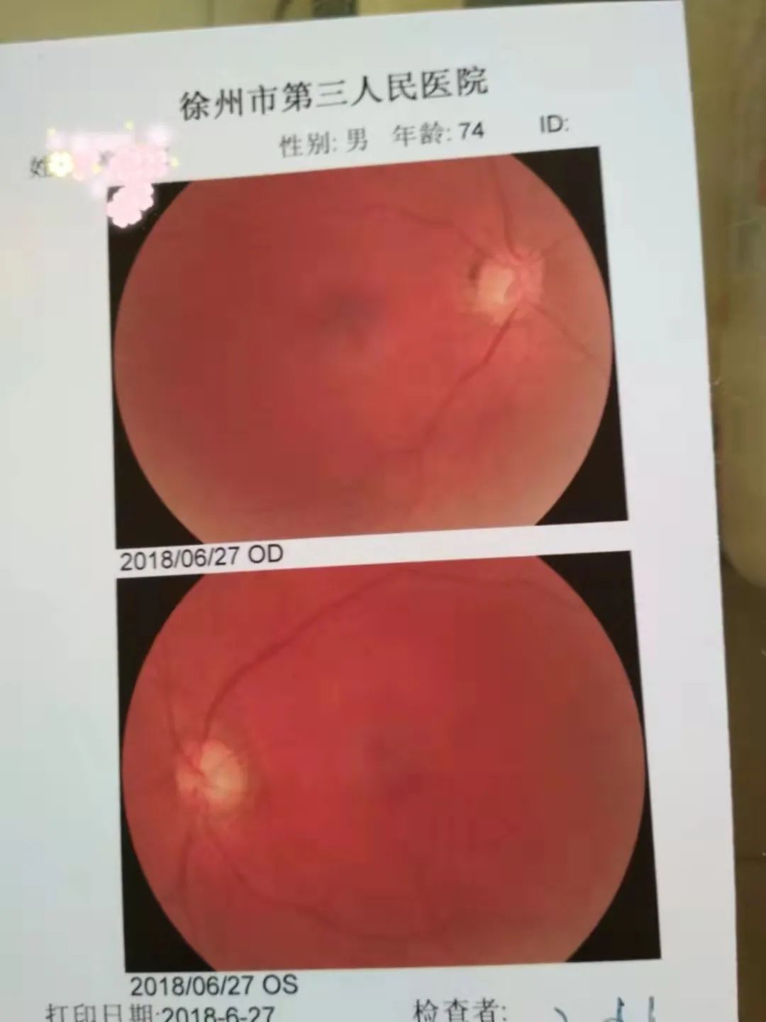 我患糖尿病47年,糖尿病血糖降下来的5个常识