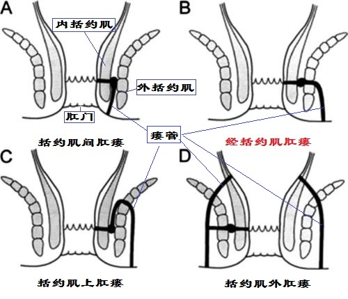 肛瘘lift手术的优缺点,lift手术治疗肛瘘后多久会复发