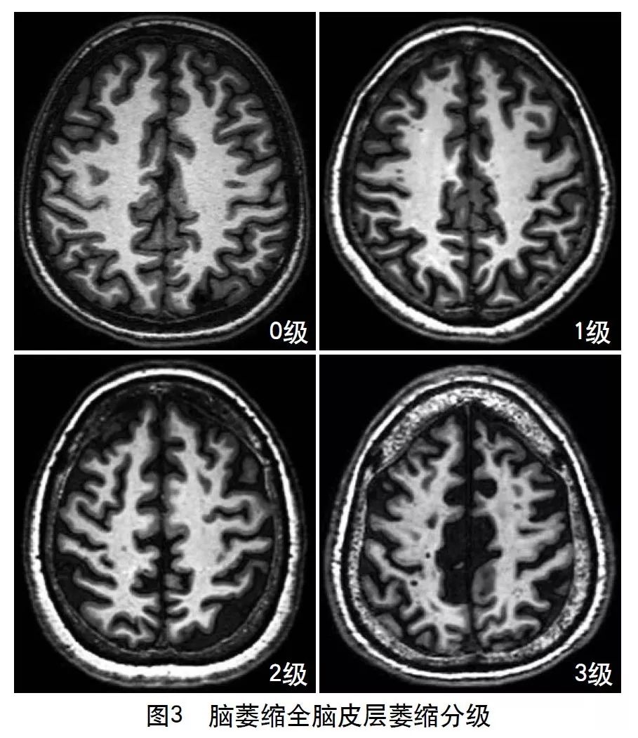 容易被误诊漏诊的脑小血管病,脑小血管病的基础知识