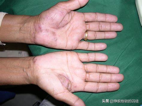 手每年春天手掌脱皮是什么原因,每年初夏手就开始脱皮