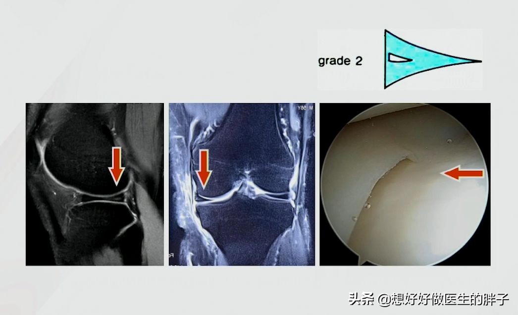 足球运动员为什么没有半月板,足球到底伤半月板吗