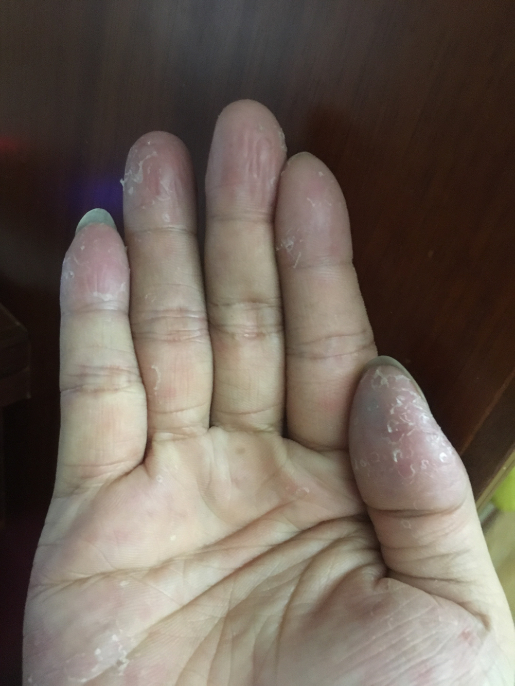 每年初夏手都会脱皮是怎么回事,手每年春天手掌脱皮是什么原因