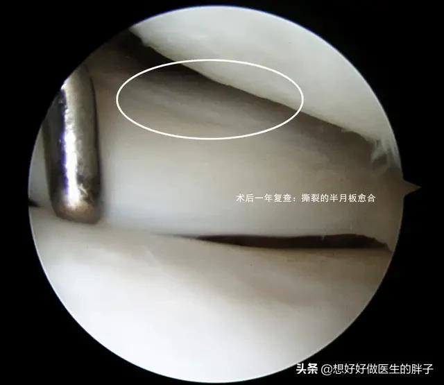 半月板三度撕裂该如何保守治疗,半月板三度撕裂还可以保守治疗吗