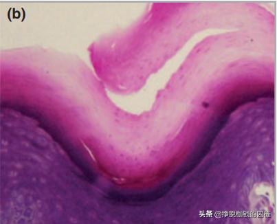 每年初夏手都会脱皮是怎么回事,手每年春天手掌脱皮是什么原因