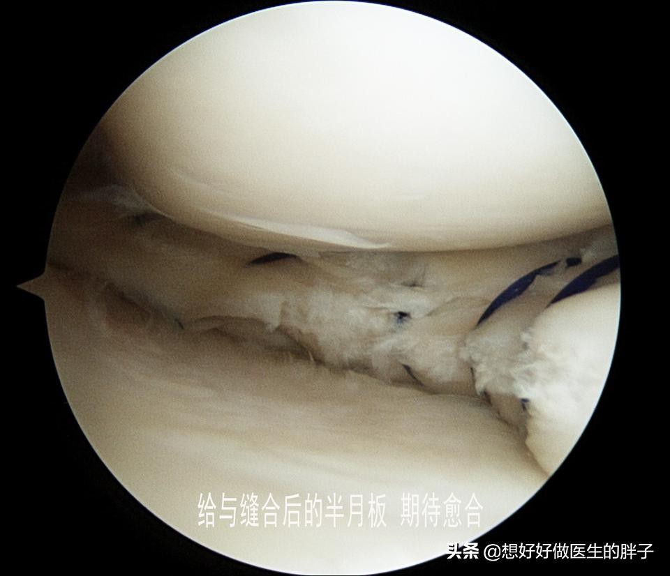 足球运动员有半月板问题吗,足球运动员为什么没有半月板