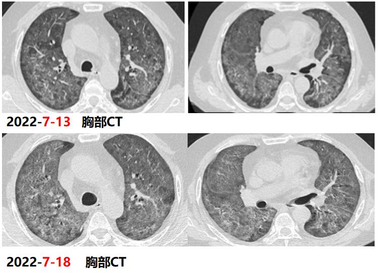 hiv感染肺孢子菌肺炎,hiv患者检查出耶氏肺孢子菌