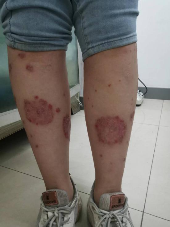 【门诊医讯】河北省人民医院皮肤科专病门诊——银屑病门诊