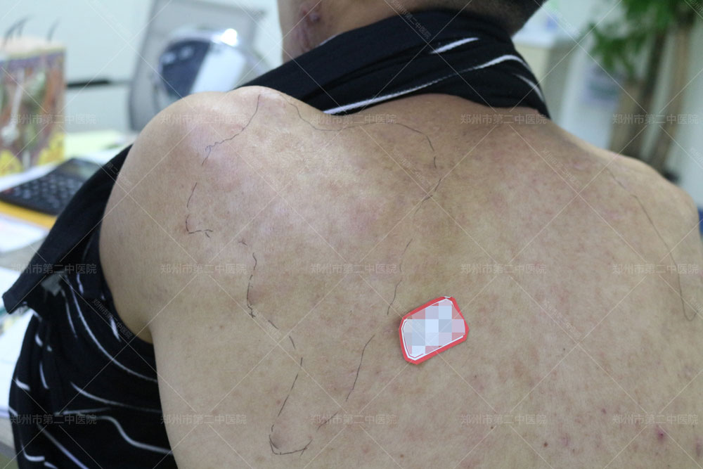 郑大一附院疤痕疙瘩怎么去除,中医怎样治疗增生性疤痕疙瘩