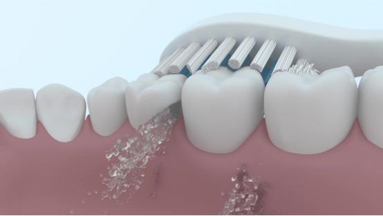 电动牙刷真的有效吗,牙科医生说电动牙刷的利弊