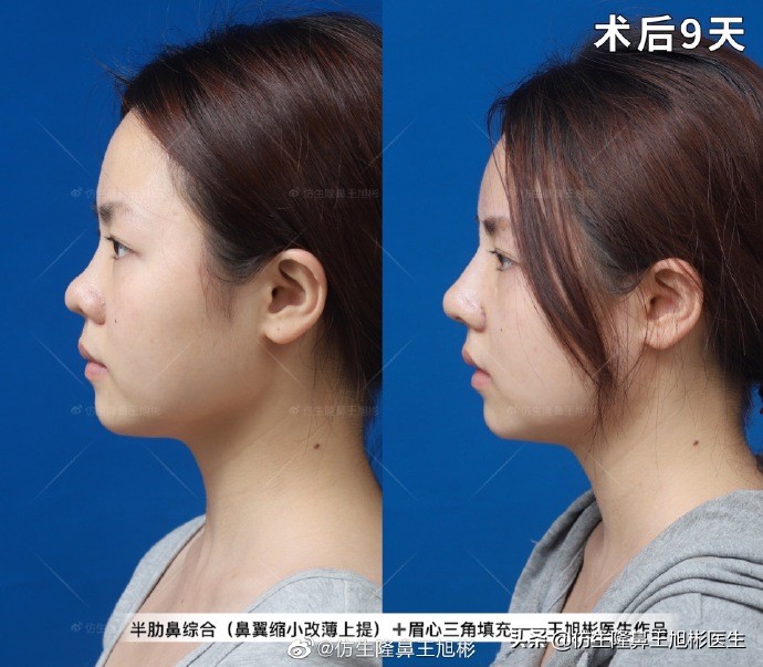 常见鼻部整形美容项目,整形鼻和自然鼻